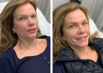 before and after microblading